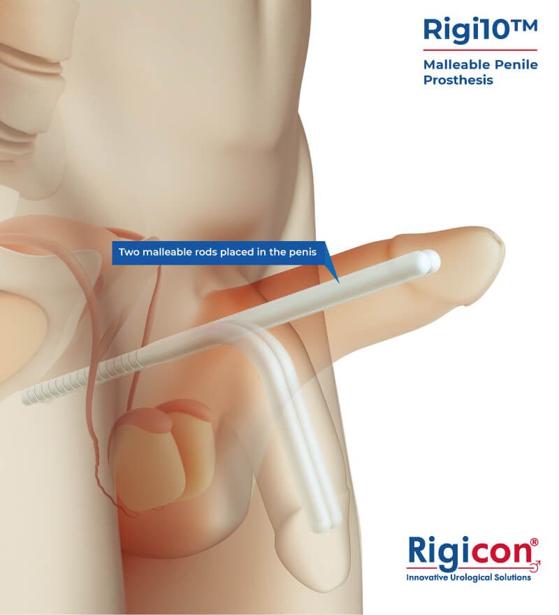 Rigi10™ Malleable Penile Prosthesis